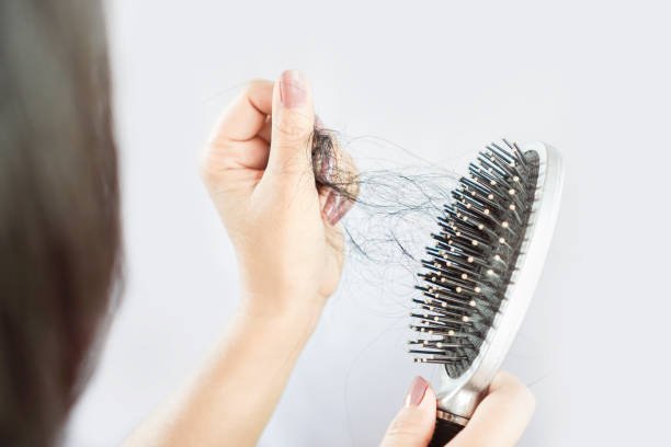 Alopecia areata